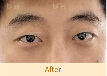 真實醫療案例 2 after