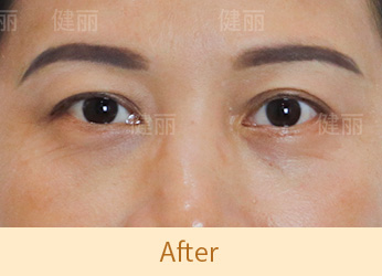 真實醫療案例 3 after
