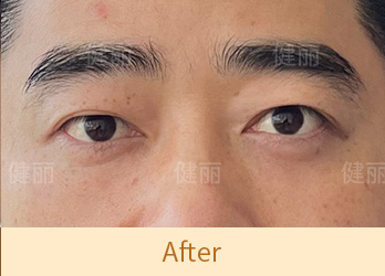 真實醫療案例 4 after