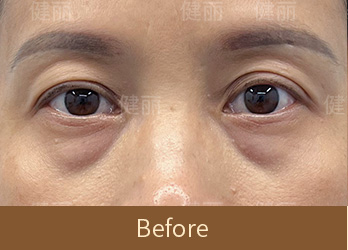 真實醫療案例 3 before