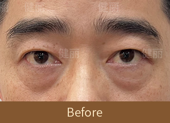 真實醫療案例 4 before