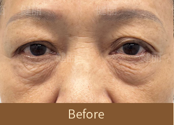 真實醫療案例 5 before