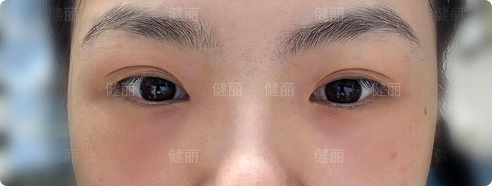 術後第1天