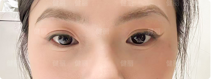 術後第15天
